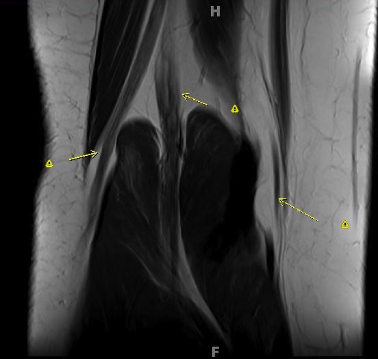 Figure 3 for case Charcot Marie Tooth Type 1a